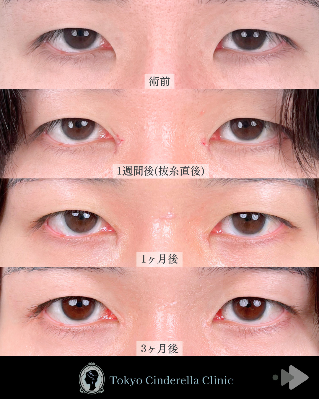 池袋院で行ったMD式目頭切開整形で有名な名医の石井達也の症例写真