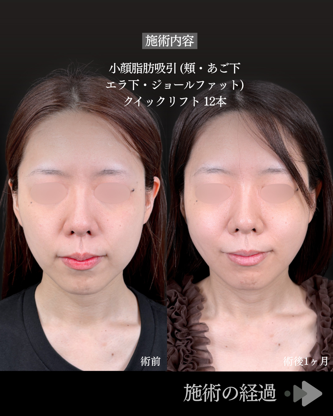 池袋院で行った小顔脂肪吸引(頬・あご下・エラ下・ジョールファット) と糸リフト整形で有名な名医の石井達也の症例写真