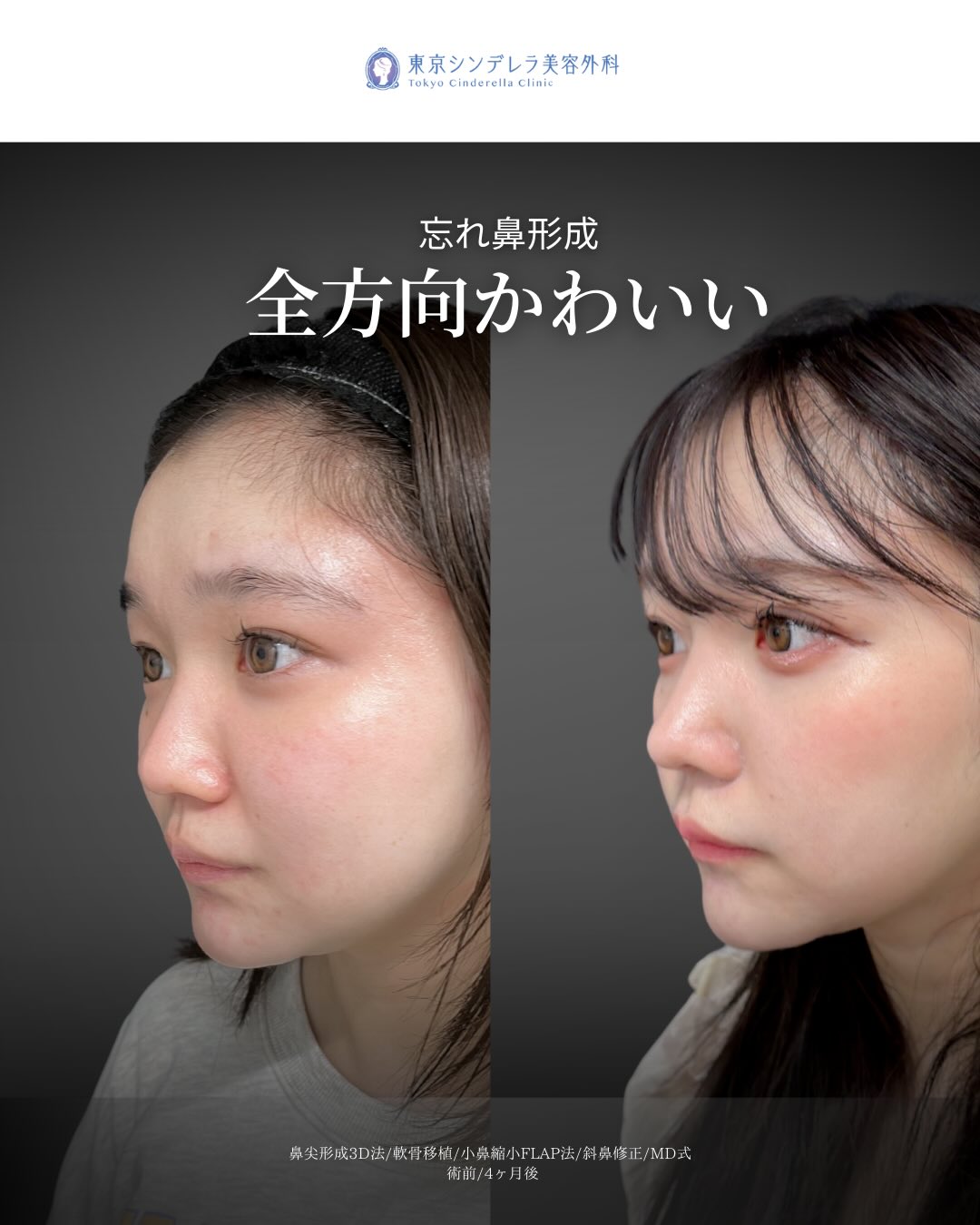 新宿院で行ったMD式の鼻尖形成3D法と軟骨移植と斜鼻修正と小鼻縮小FLAP法の4ヵ月後の症例写真