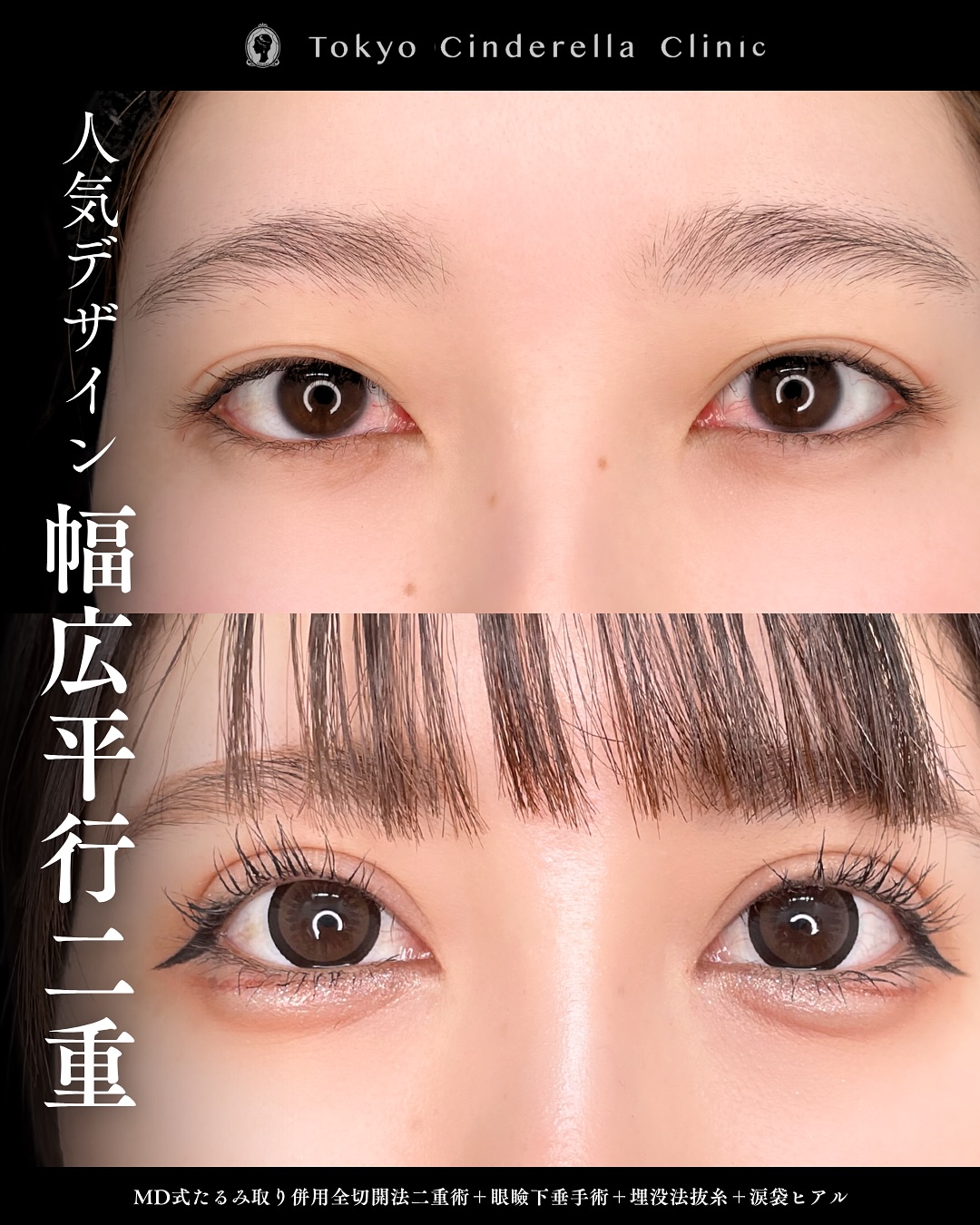 新宿院で行った二重整形で有名な吉原伯医師のMD式のたるみ取り併用全切開法二重術と眼瞼下垂手術と涙袋ヒアルロン酸注入の６ヶ月後の症例写真