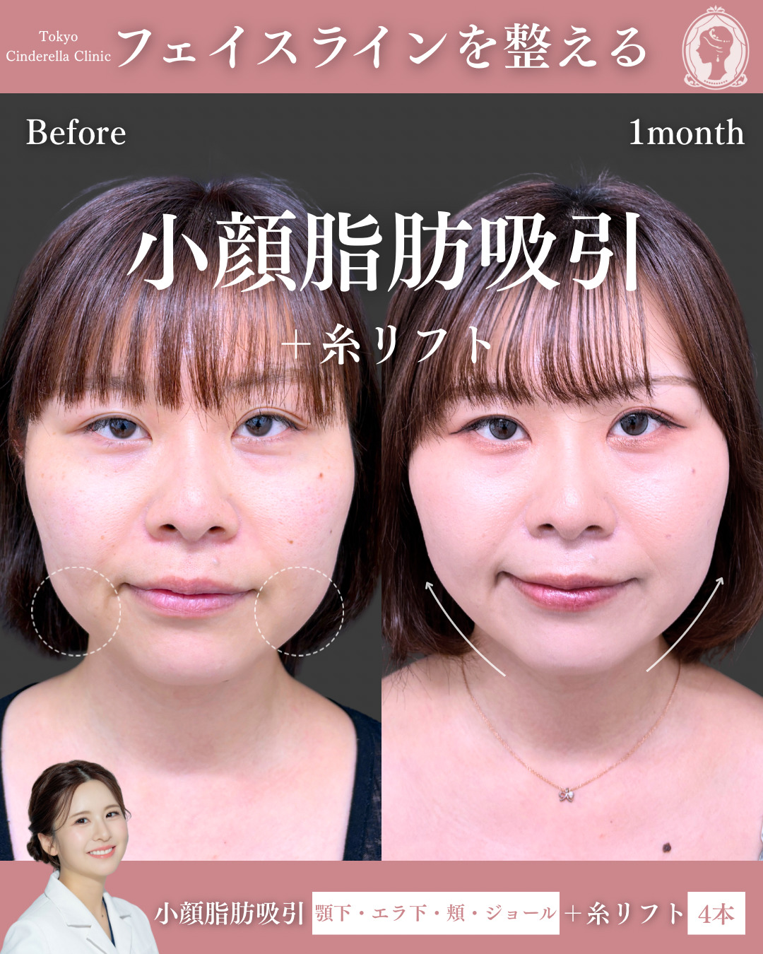 新宿院で行った小顔脂肪吸引の名医の梅田彩乃医師の症例写真