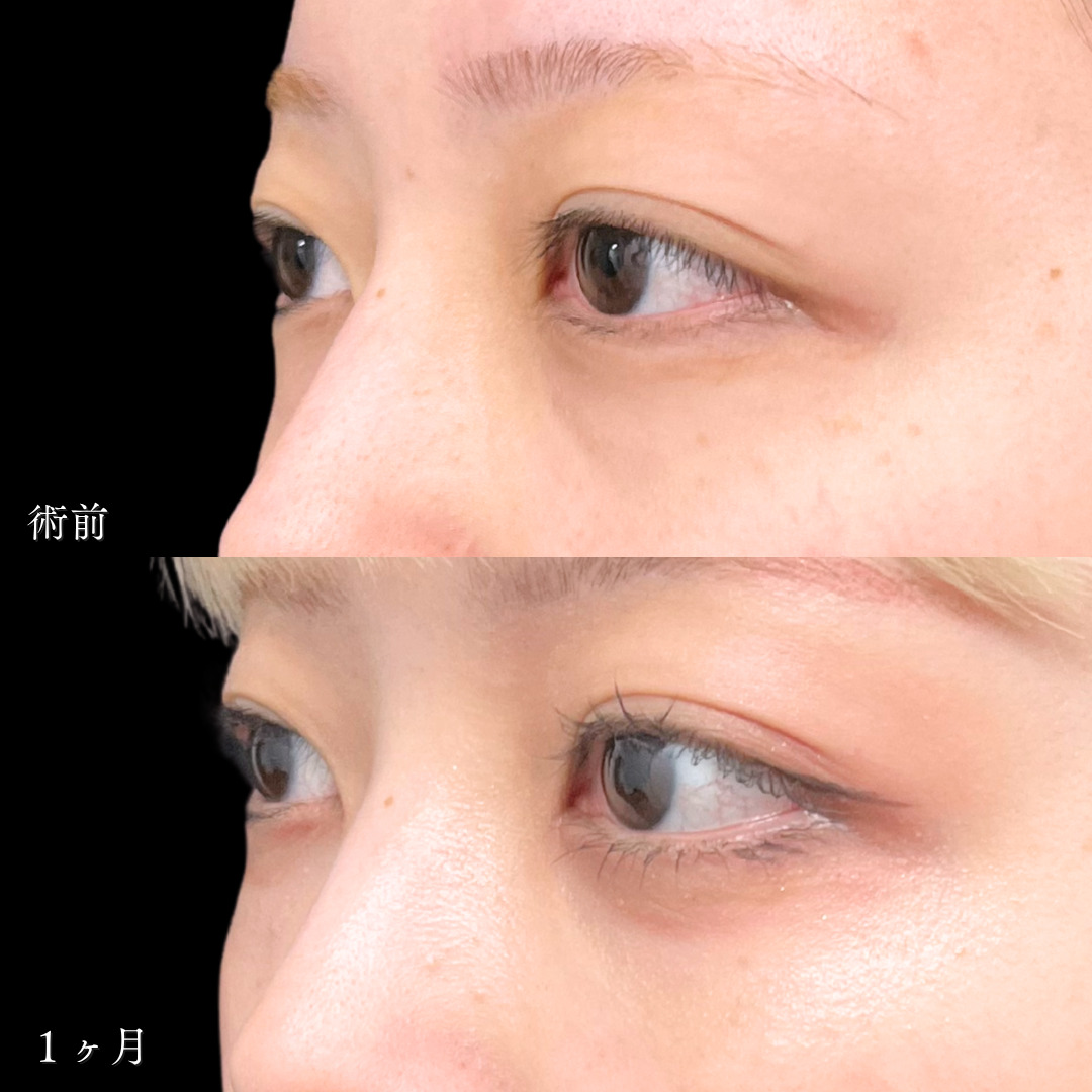 切らないクマ取りとヒアルロン酸注入で若々しい目元に変化した１ヶ月目症例