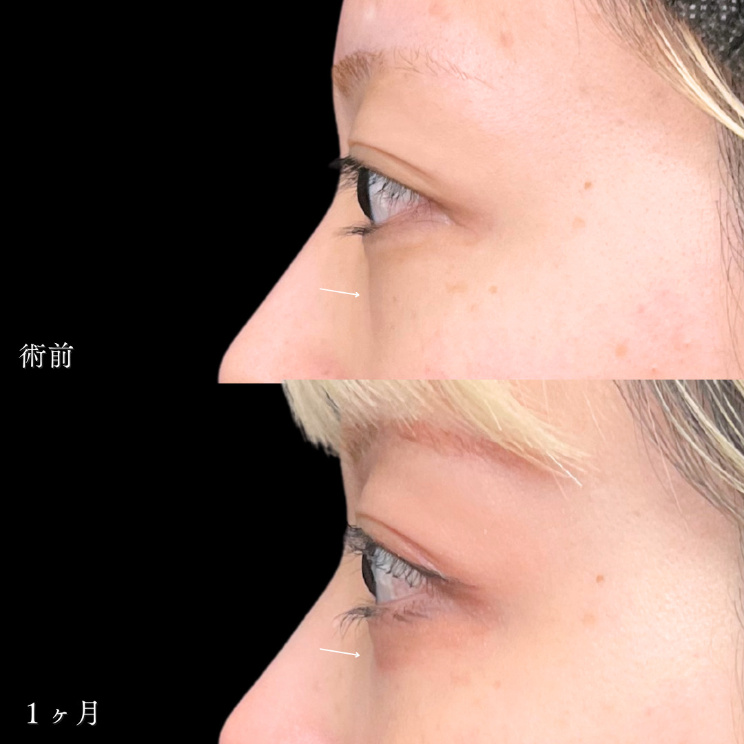 切らないクマ取りとヒアルロン酸注入で若々しい目元に変化した１ヶ月目症例