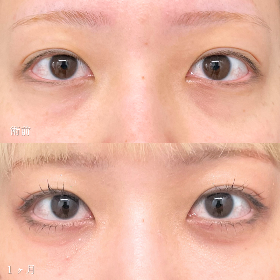 切らないクマ取りとヒアルロン酸注入で若々しい目元に変化した１ヶ月目症例