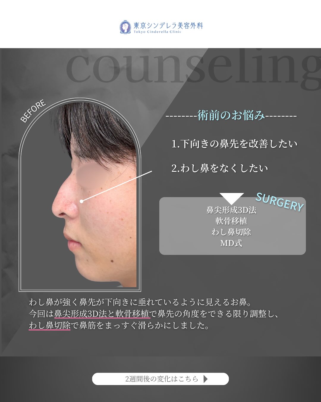 新宿院で行ったMD式の鼻尖形成3D法と軟骨移植とわし鼻切除の2週間後の症例写真