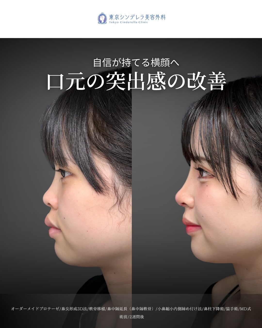 新宿院で行った鼻尖形成3D法と軟骨移植と鼻中隔延長と小鼻縮小内側締め付け法と鼻柱下降術と猫手術の鼻フル整形を行った2週間後の口元の突出感が改善された症例写真