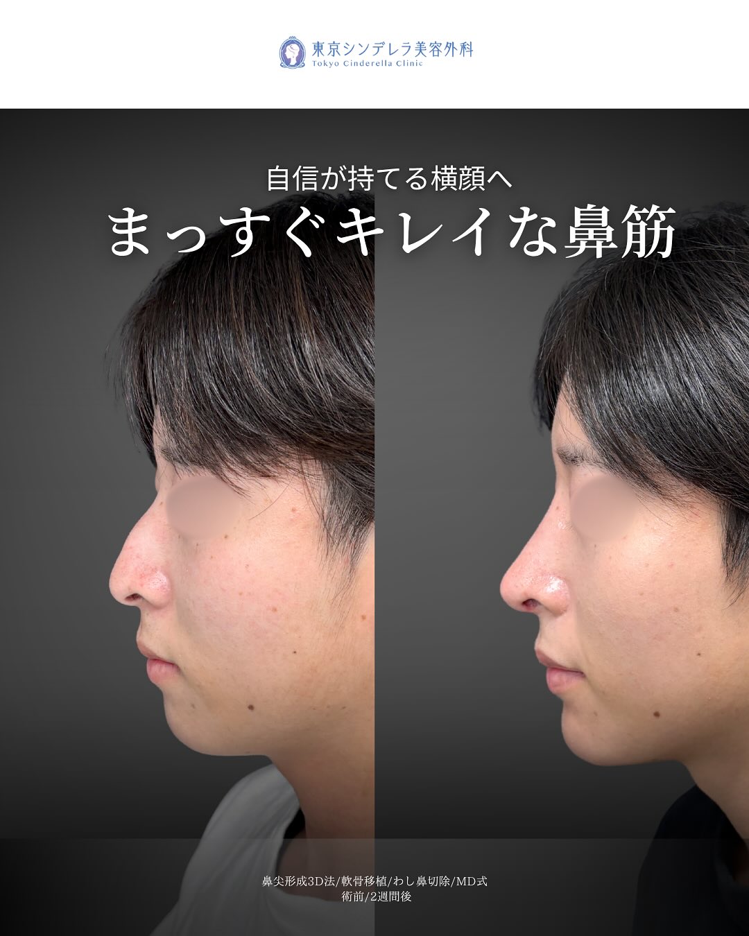 新宿院で行ったMD式の鼻尖形成3D法と軟骨移植とわし鼻切除の2週間後の症例写真