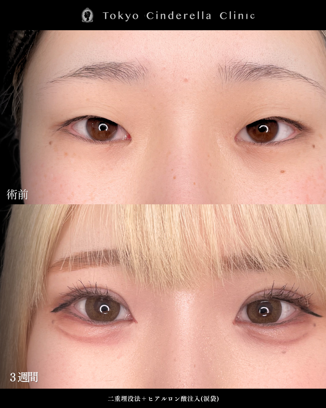 二重埋没法と涙袋ヒアルで可愛い末広二重になった３週間比較症例