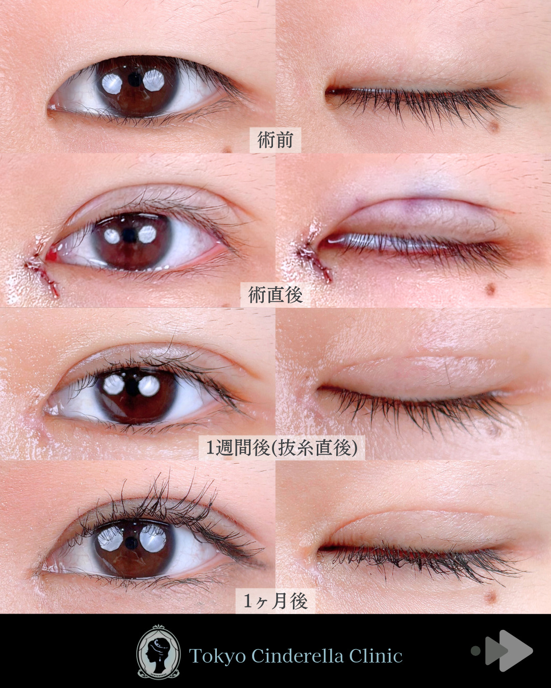 池袋院で行った韓国式自然癒着法6点と目頭切開整形で有名な名医の石井達也の症例写真