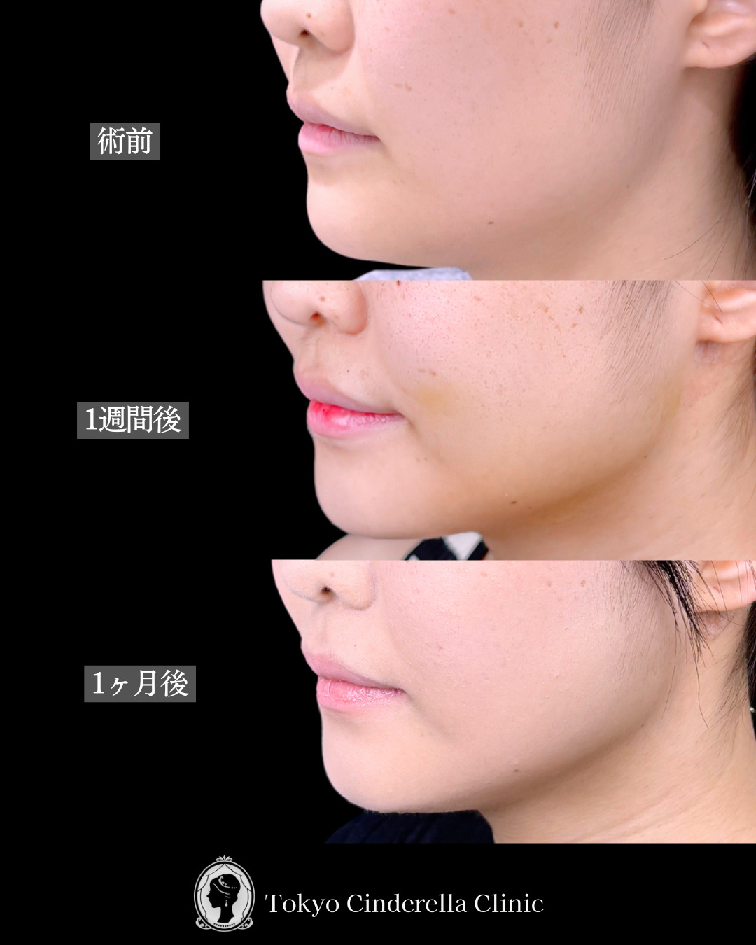 池袋院で行ったアキーセル小顔脂肪吸引(頬・あご下・エラ下・ジョールファット) と糸リフト8本整形で有名な名医の石井達也の症例写真