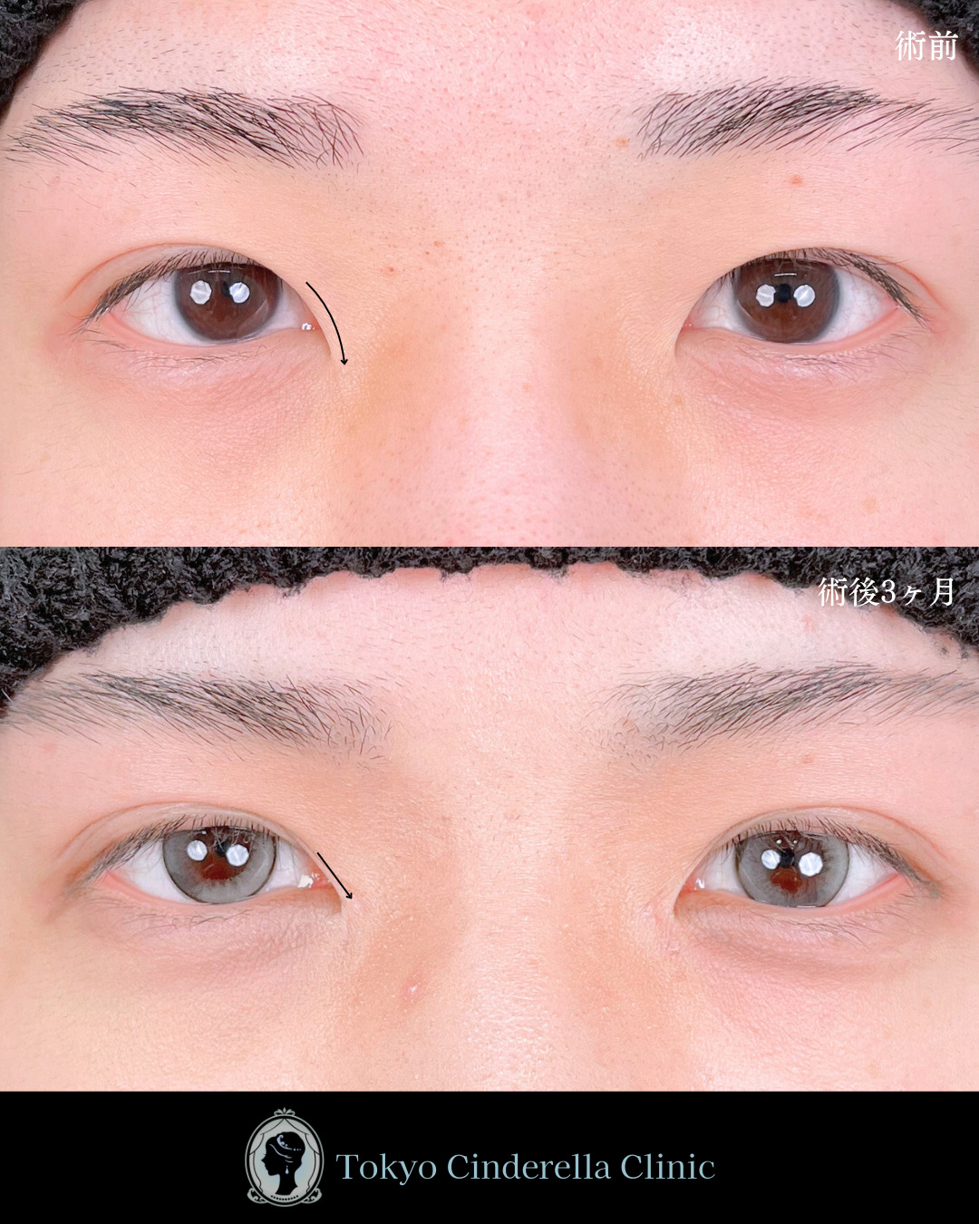 池袋院で行った目頭切開とクイックシンデレラ・ダブル整形で有名な名医の石井達也の症例写真