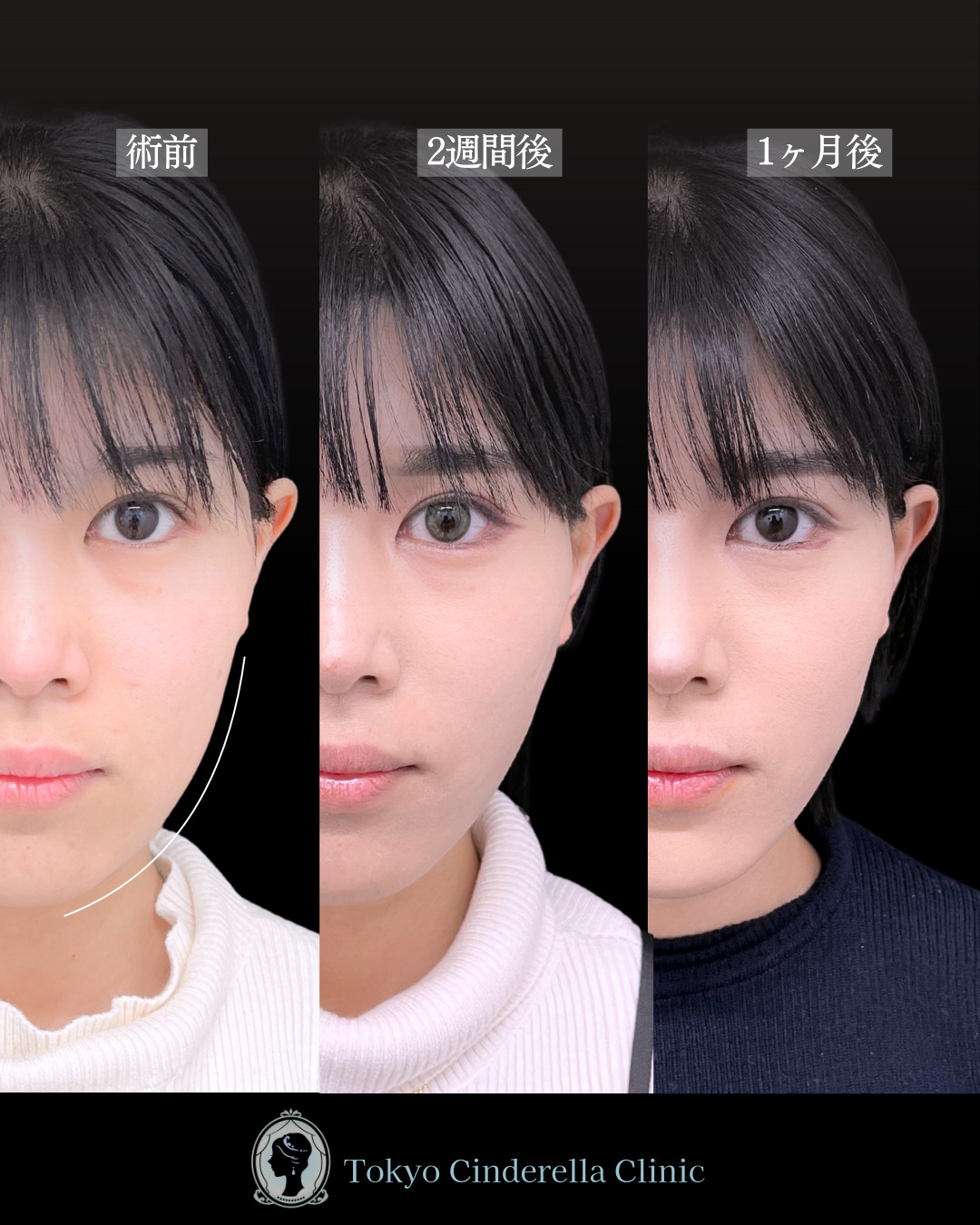 池袋院で行った小顔脂肪吸引(頬・あご下・エラ下・ジョールファット) とクイックリフト10本整形で有名な名医の石井達也の症例写真