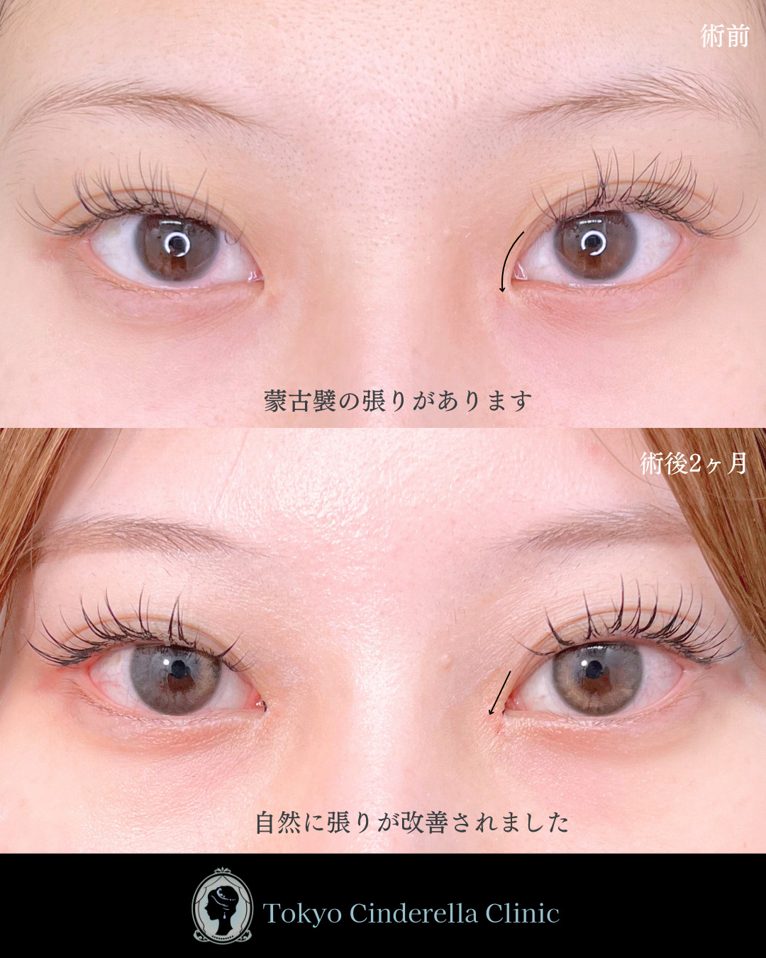 池袋院で行ったMD式目頭切開整形で有名な名医の石井達也の症例写真