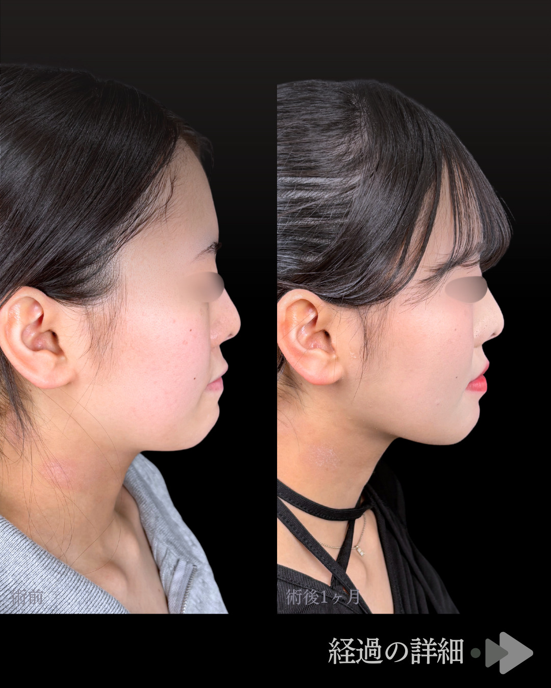 池袋院で行ったアキーセル脂肪吸引(頬・あご下・エラ下・ジョールファット) とクイックリフト12本整形で有名な名医の石井達也の症例写真