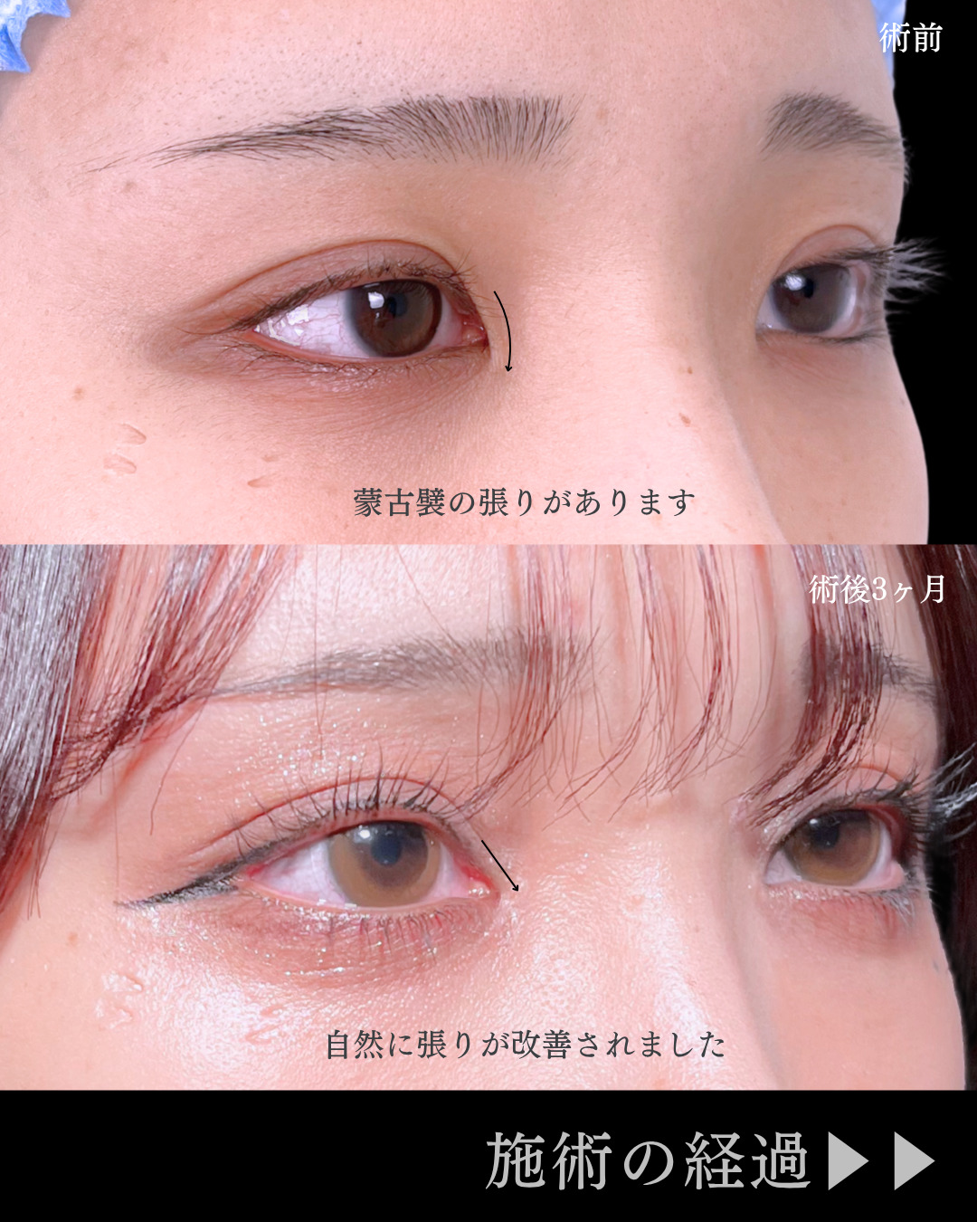 池袋院で行ったMD式目頭切開整形で有名な名医の石井達也の症例写真