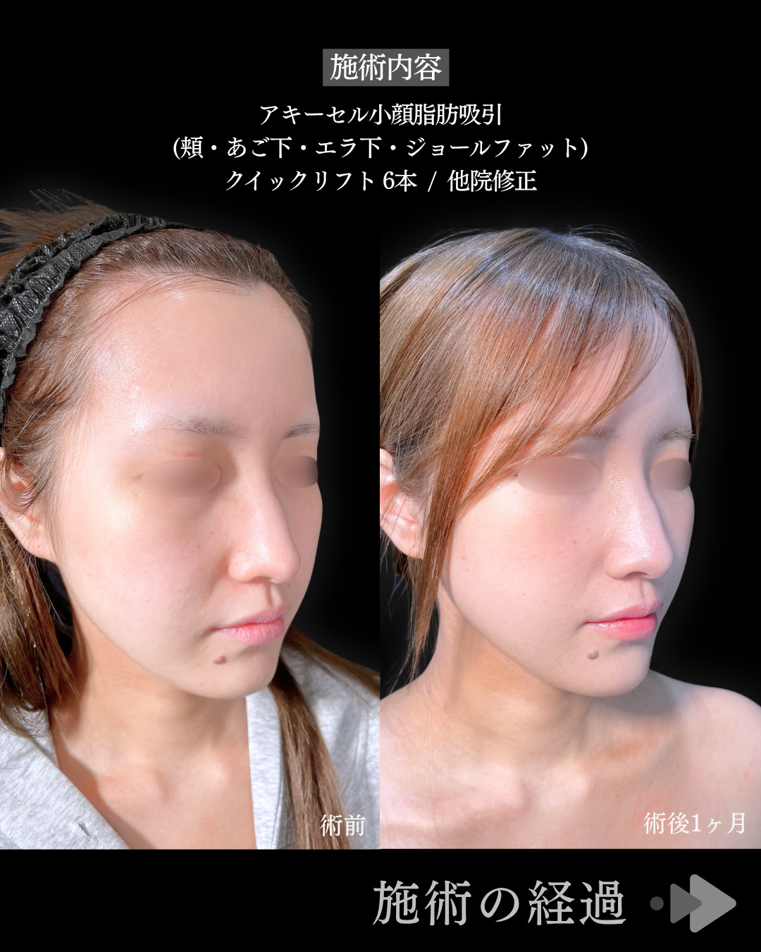 池袋院で行ったアキーセル小顔脂肪吸引(頬・あご下・エラ下・ジョールファット) と糸リフト６本と他院修正整形で有名な名医の石井達也の症例写真