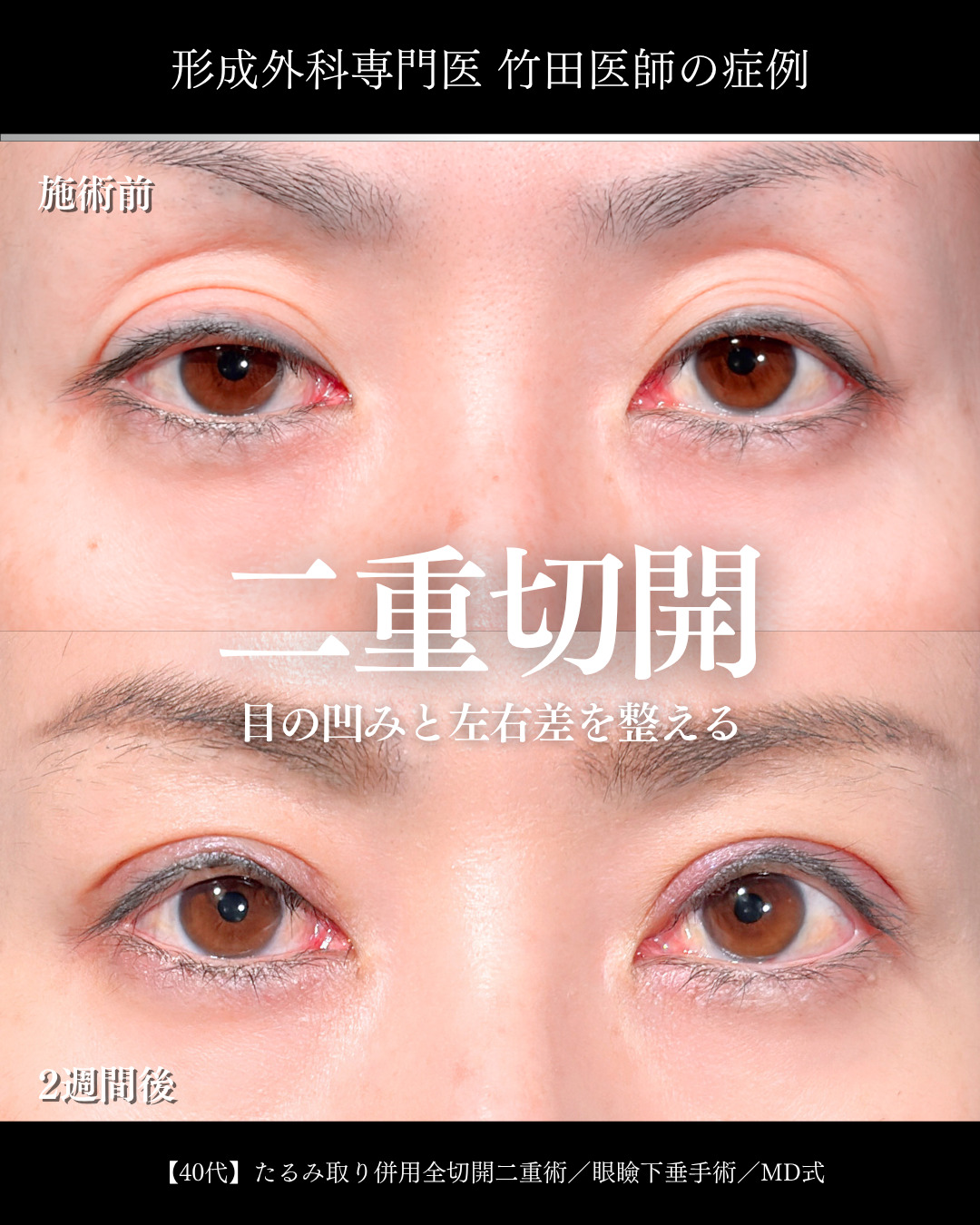 大宮院で行った二重整形で有名な竹田昌平医師の二重切開と眼瞼下垂手術の症例写真