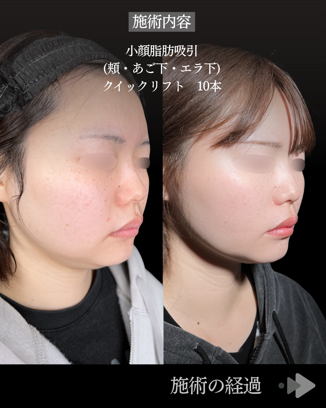 池袋院で行った小顔脂肪吸引(頬・あご下・エラ下)/クイックリフト 10本整形で有名な名医の石井達也の症例写真