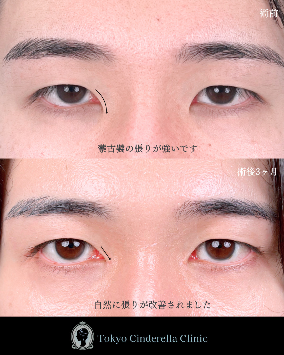 池袋院で行ったMD式目頭切開整形で有名な名医の石井達也の症例写真