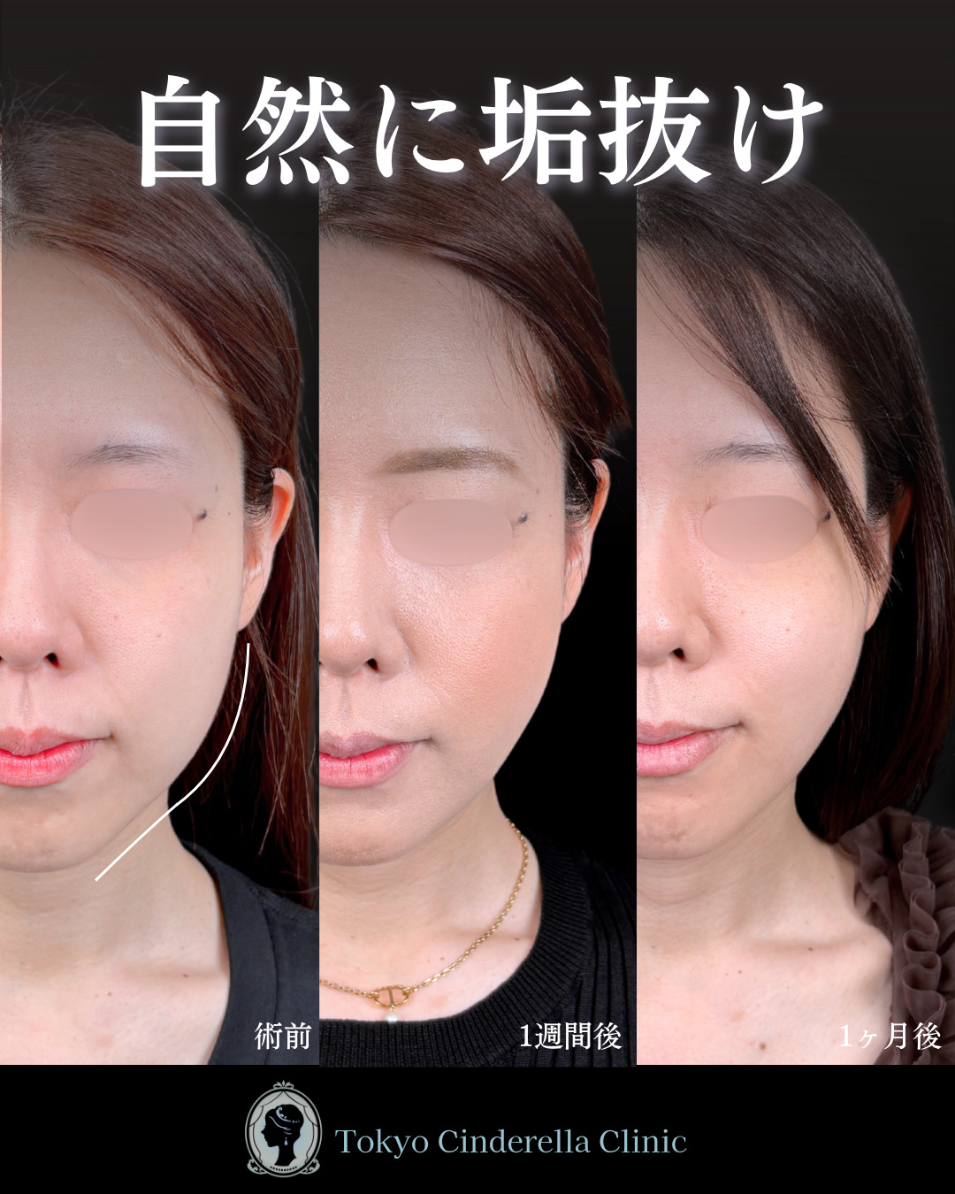 池袋院で行った小顔脂肪吸引(頬・あご下・エラ下・ジョールファット) と糸リフト整形で有名な名医の石井達也の症例写真