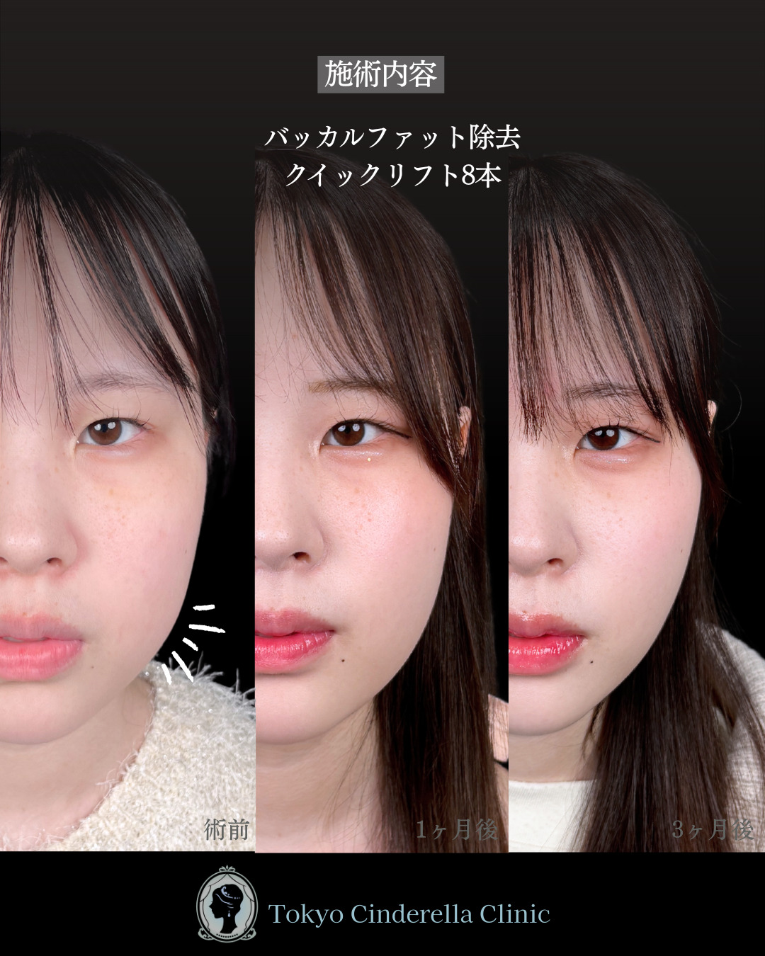 池袋院で行ったバッカルファット除去とクイックリフト 8本整形で有名な名医の石井達也の症例写真