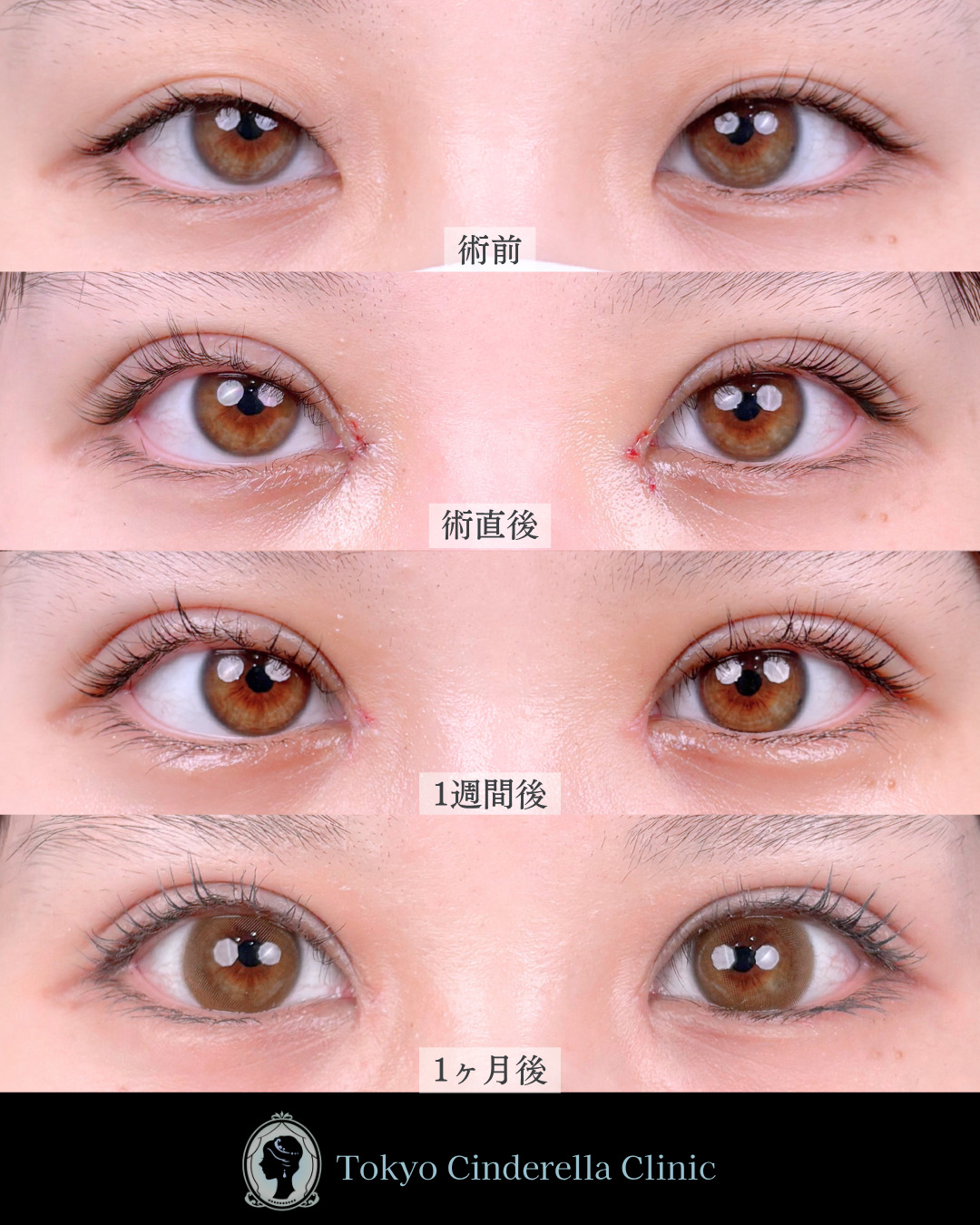 池袋院で行った二重埋没法とMD式目頭切開整形で有名な名医の石井達也の症例写真