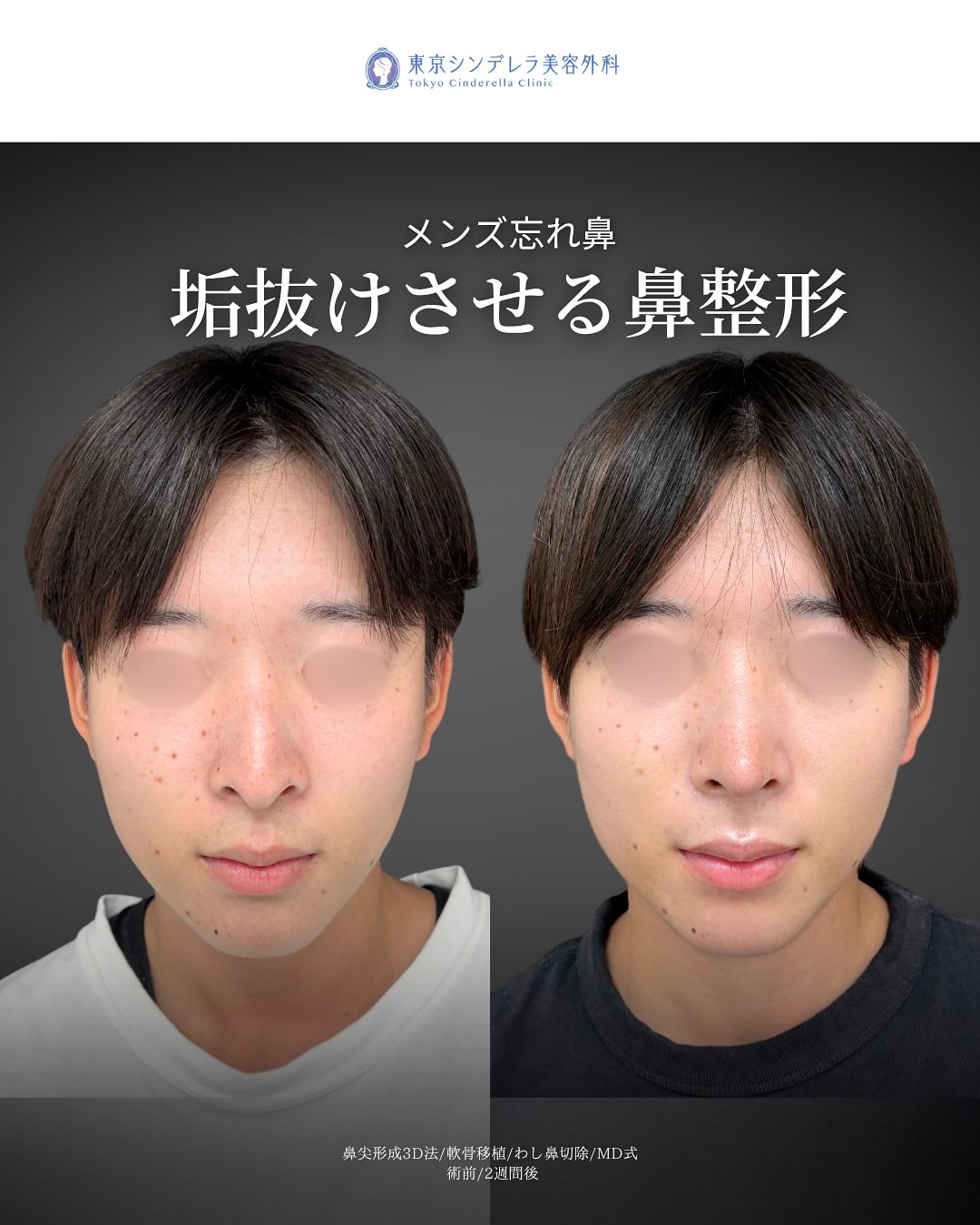 新宿院で行ったMD式の鼻尖形成3D法と軟骨移植とわし鼻切除の2週間後の症例写真