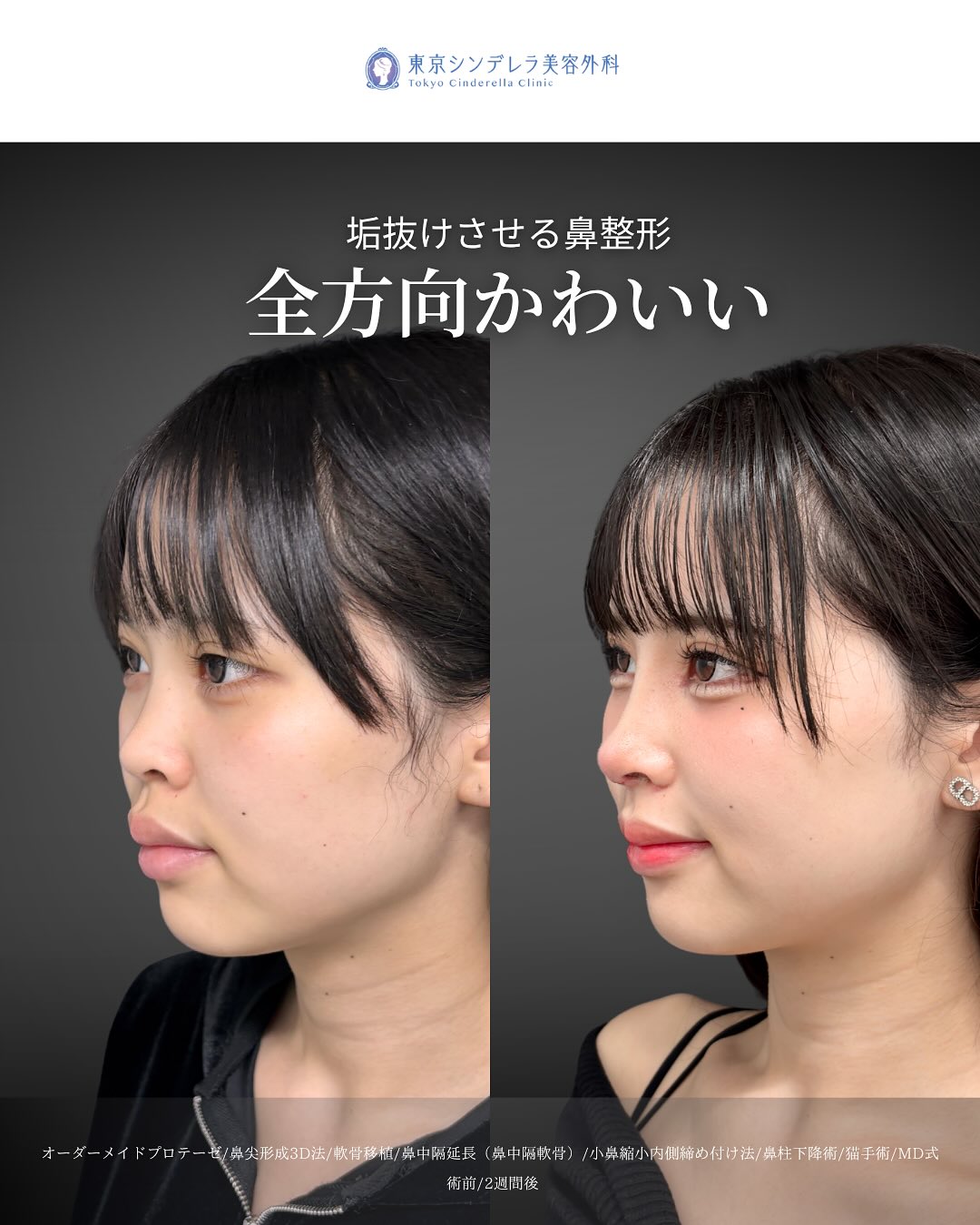 新宿院で行った鼻尖形成3D法と軟骨移植と鼻中隔延長と小鼻縮小内側締め付け法と鼻柱下降術と猫手術の鼻フル整形を行った2週間後の口元の突出感が改善された症例写真