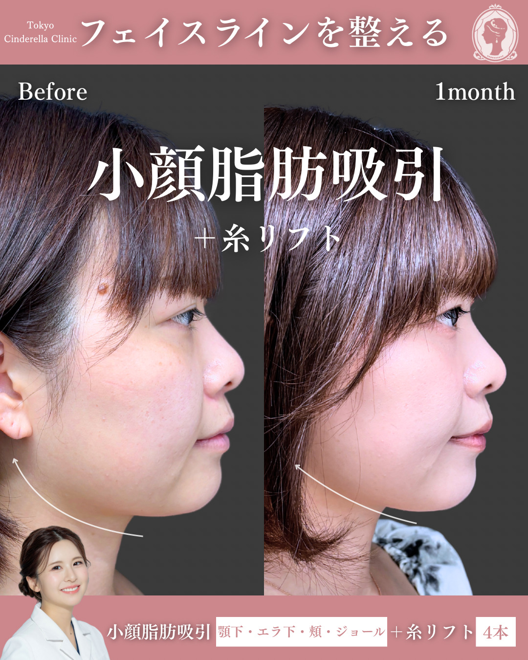 新宿院で行った小顔脂肪吸引の名医の梅田彩乃医師の症例写真
