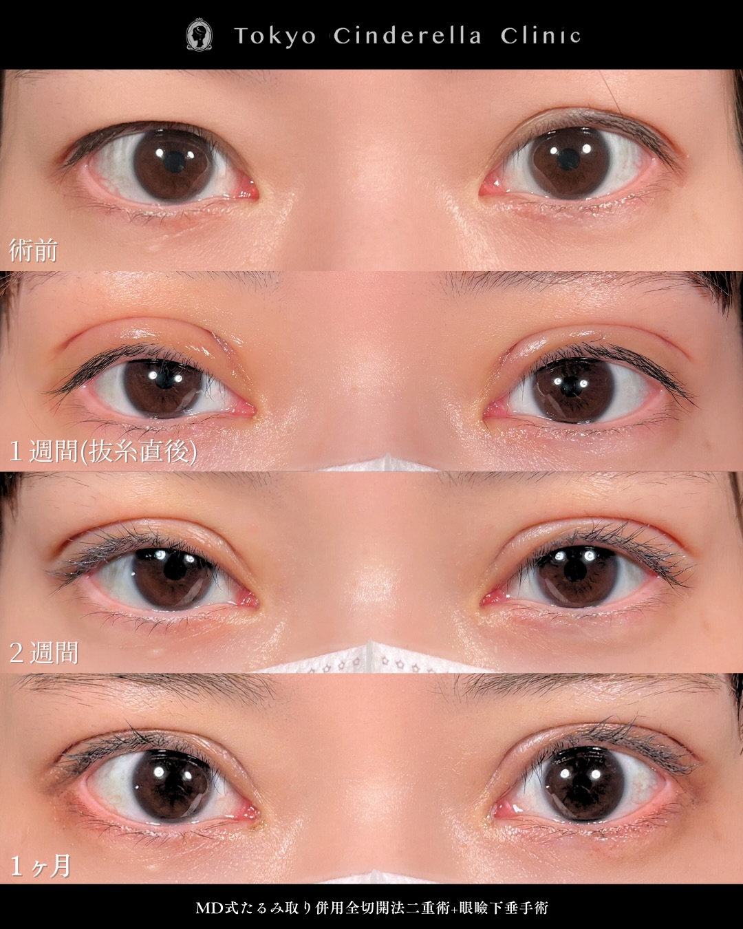 新宿院で行った吉原伯医師のMD式のたるみ取り併用全切開法二重術と眼瞼下垂手術の1ヵ月後までのダウンタイム症例写真