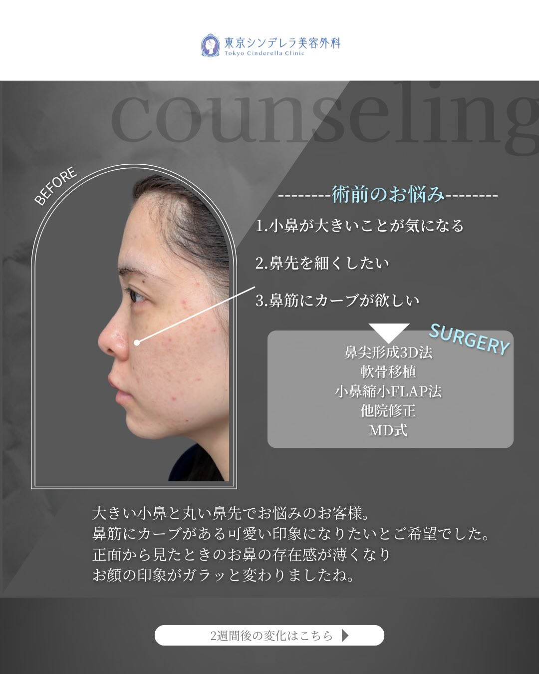 新宿院で行った鼻尖形成3D法と軟骨移植と小鼻縮小FLAP法と他院修正の2週間後の症例写真