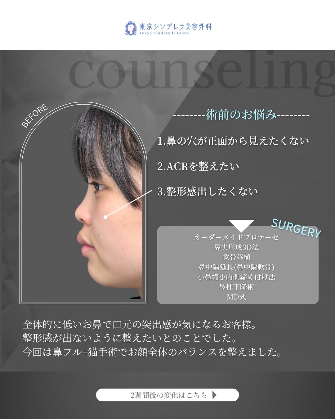 新宿院で行った鼻尖形成3D法と軟骨移植と鼻中隔延長と小鼻縮小内側締め付け法と鼻柱下降術と猫手術の鼻フル整形を行い口元の突出感が改善された2週間後の症例写真