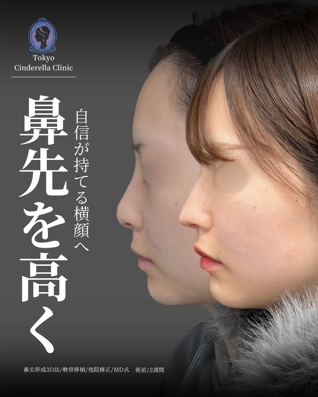 新宿院で行った鼻尖形成3D法と軟骨移植の2週間後の症例写真