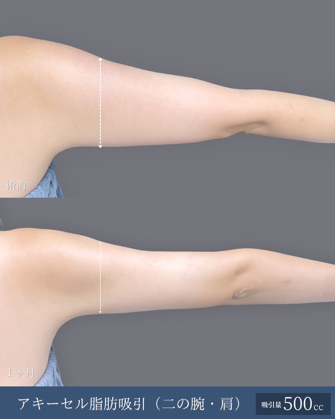新宿院で行った二の腕と肩のアキーセル脂肪吸引の名医の吉原伯医師の症例写真