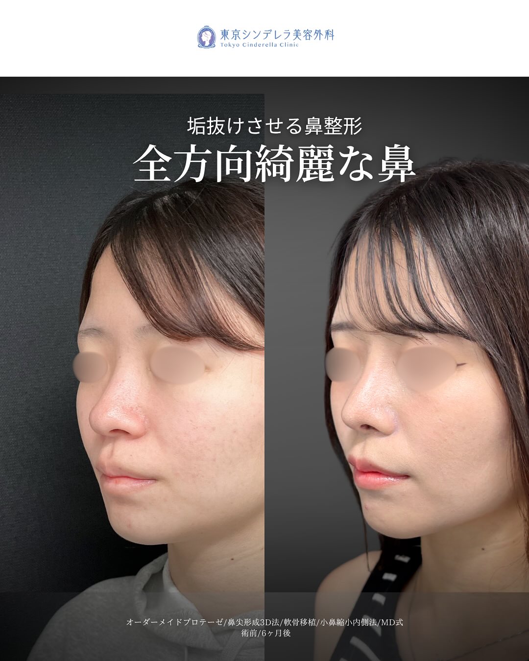 新宿院で行ったMD式鼻尖形成3D法と軟骨移植とオーダーメイドプロテーゼと小鼻縮小内側締め付け法の6ヵ月後の症例写真