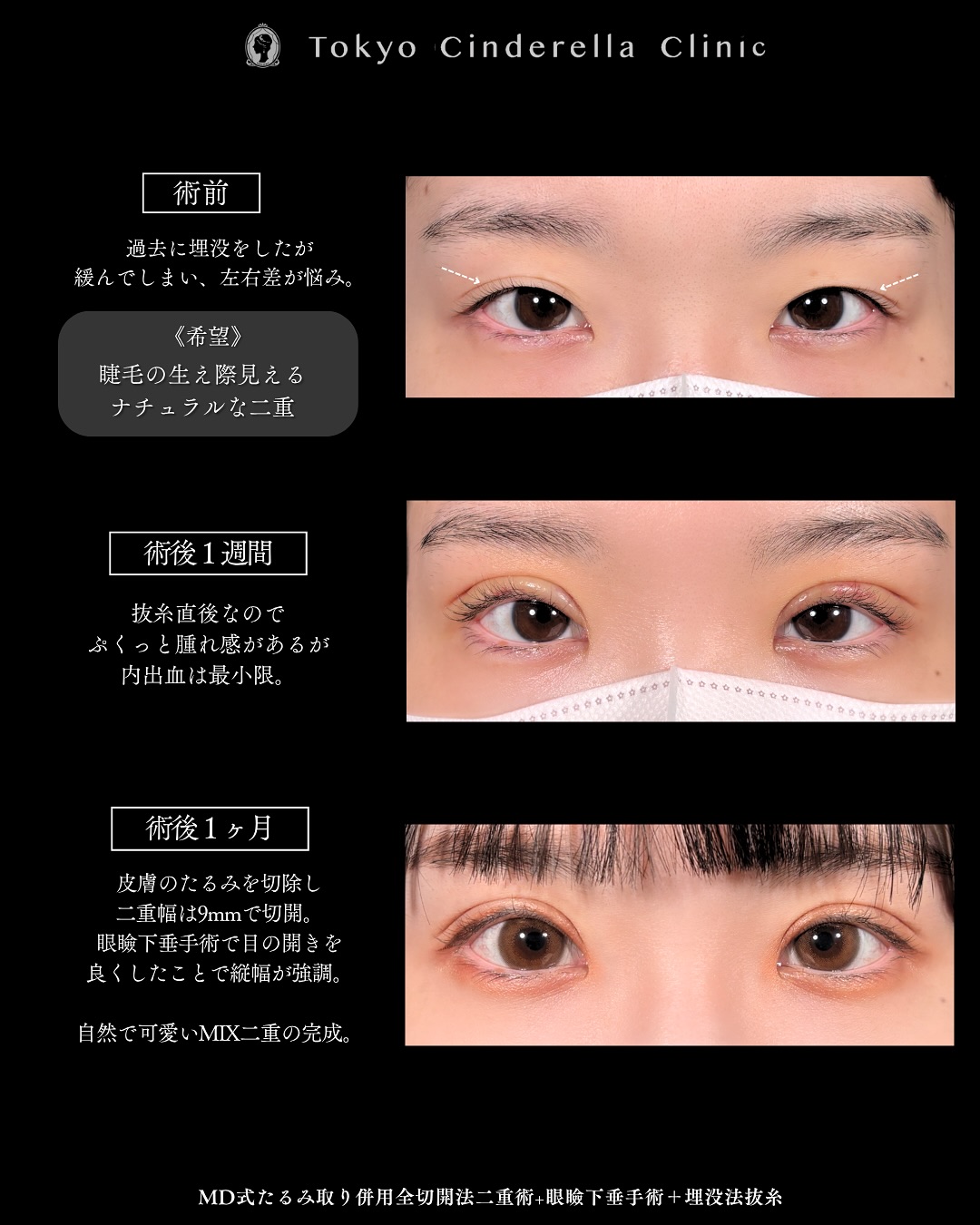 新宿院で行った二重整形で有名な吉原伯医師のMD式のたるみ取り併用全切開法二重術と眼瞼下垂手術の1ヵ月までのダウンタイム症例写真