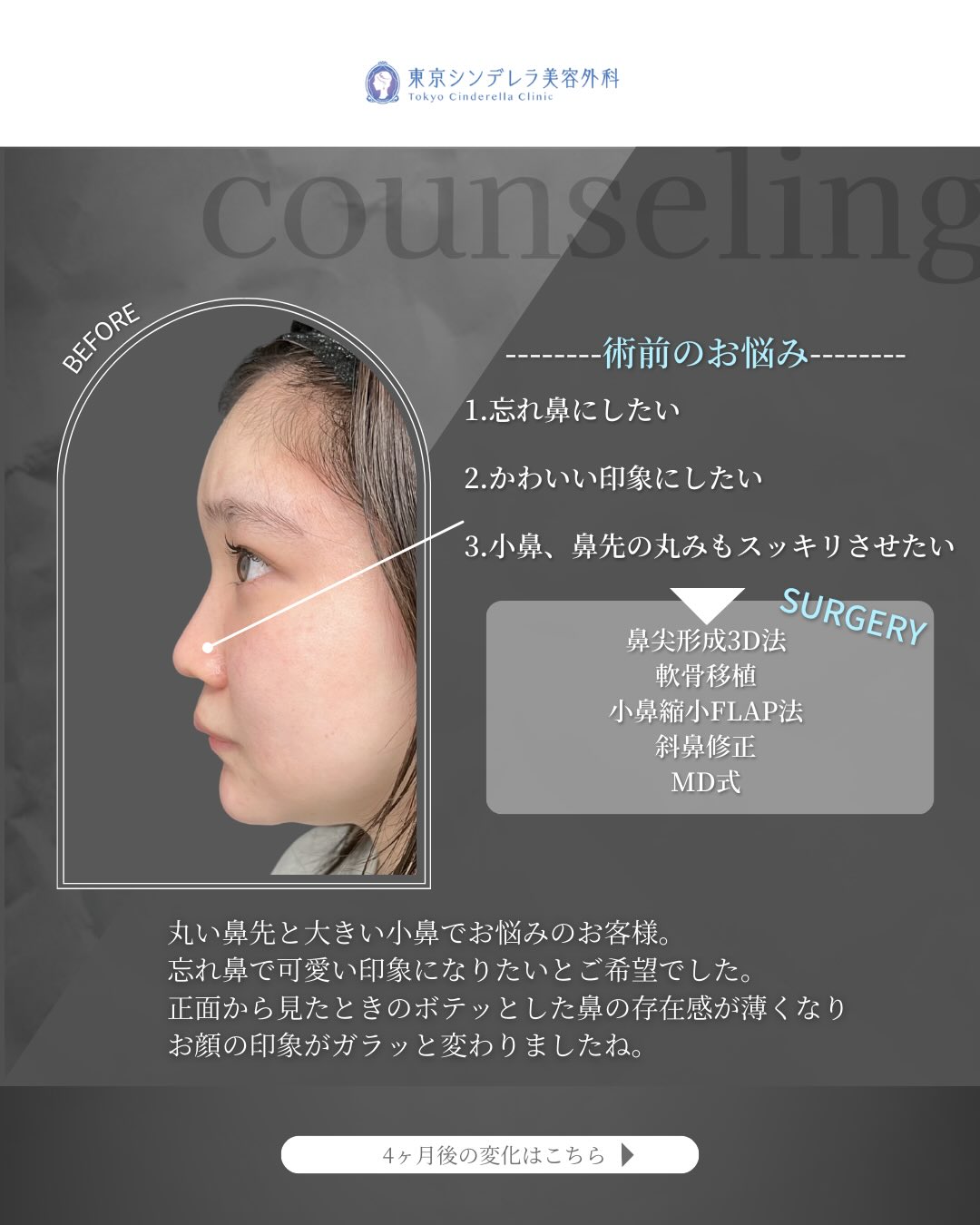 新宿院で行ったMD式の鼻尖形成3D法と軟骨移植と斜鼻修正と小鼻縮小FLAP法の4ヵ月後の症例写真