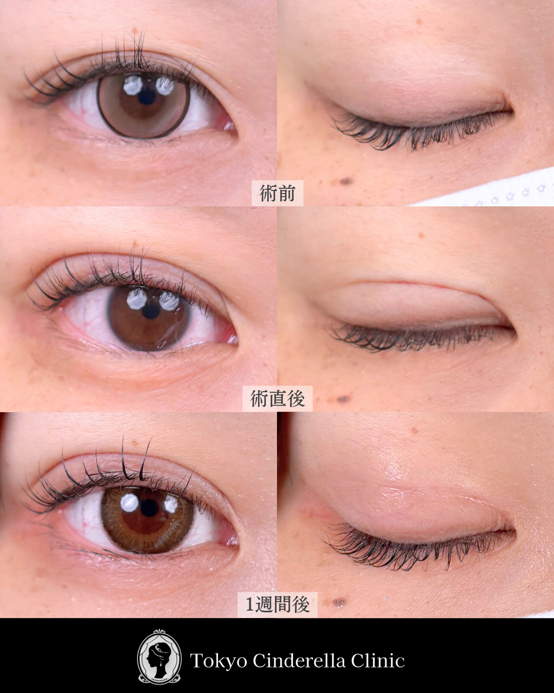 池袋院で行った韓国式自然癒着法4点整形で有名な名医の石井達也の症例写真