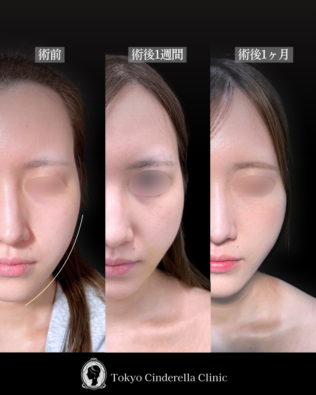 池袋院で行ったアキーセル小顔脂肪吸引(頬・あご下・エラ下・ジョールファット) と糸リフト６本と他院修正整形で有名な名医の石井達也の症例写真