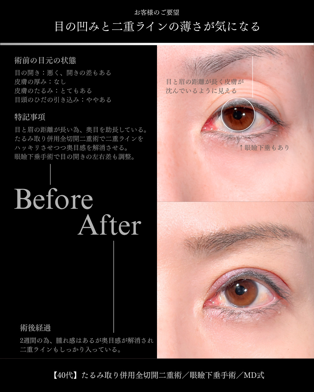 大宮院で行った二重整形で有名な竹田昌平医師の二重切開と眼瞼下垂手術の症例写真