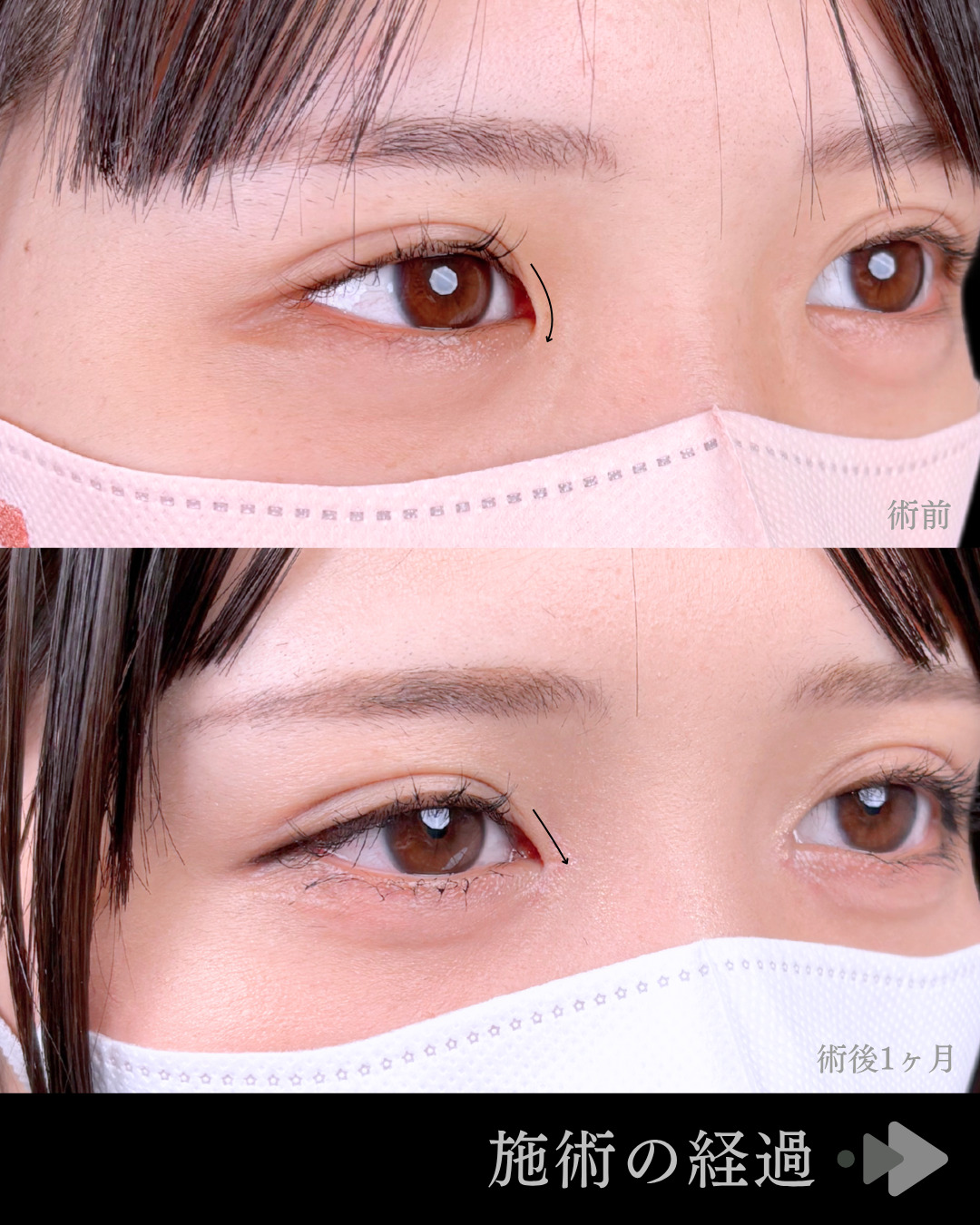 池袋院で行ったMD式目頭切開整形で有名な名医の石井達也の症例写真