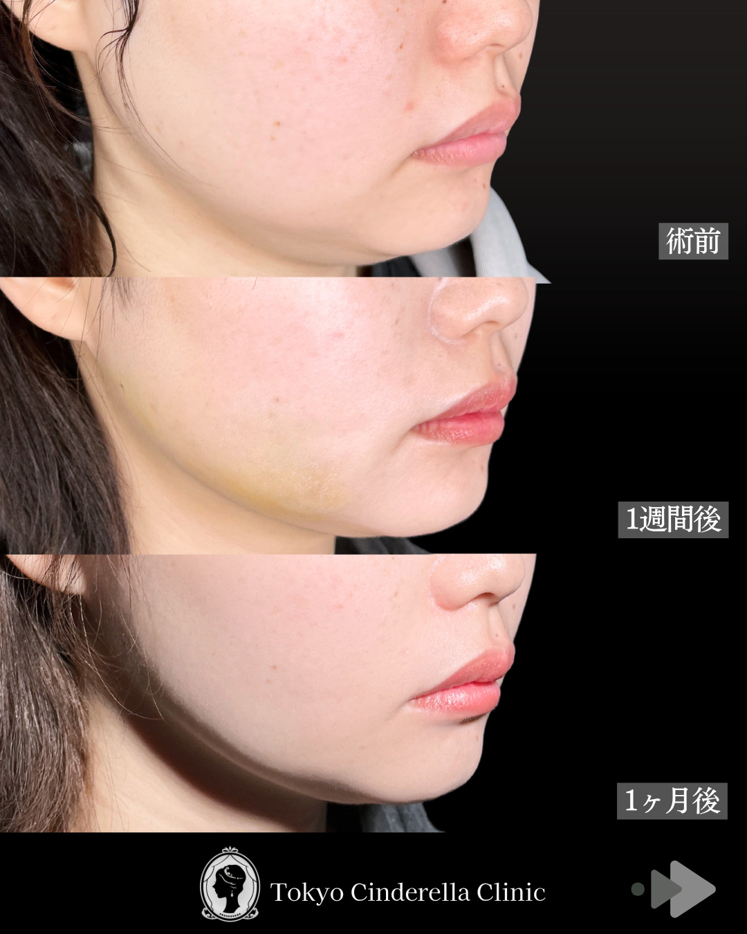 池袋院で行った小顔脂肪吸引(頬・あご下・エラ下)/クイックリフト 10本整形で有名な名医の石井達也の症例写真