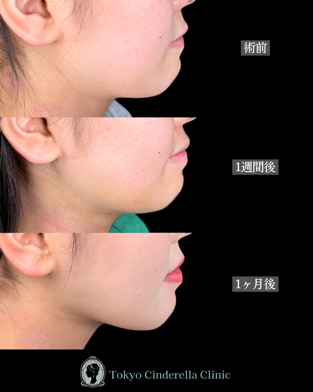 池袋院で行ったアキーセル脂肪吸引(頬・あご下・エラ下・ジョールファット) とクイックリフト12本整形で有名な名医の石井達也の症例写真