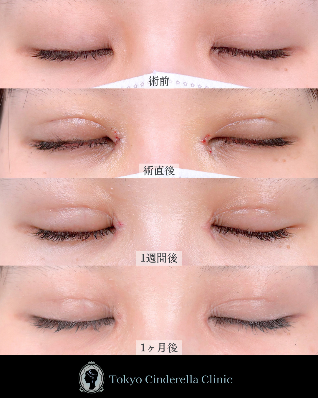 池袋院で行った二重埋没法とMD式目頭切開整形で有名な名医の石井達也の症例写真