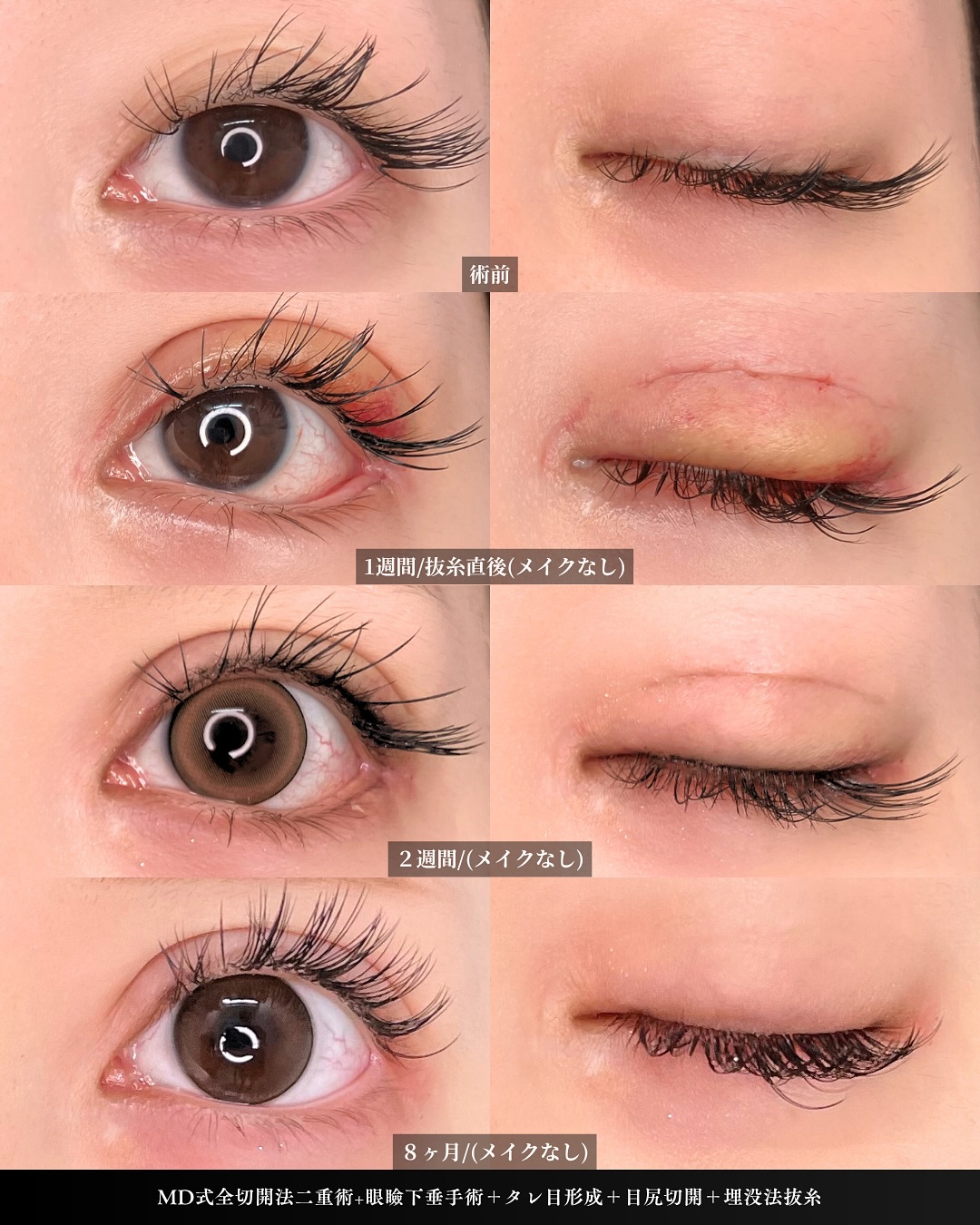 新宿院で行った二重整形で有名な吉原伯医師のMD式の全切開法二重術と眼瞼下垂手術と目尻切開とタレ目形成(結膜切開)と埋没法抜糸を行った8ヵ月後の症例写真