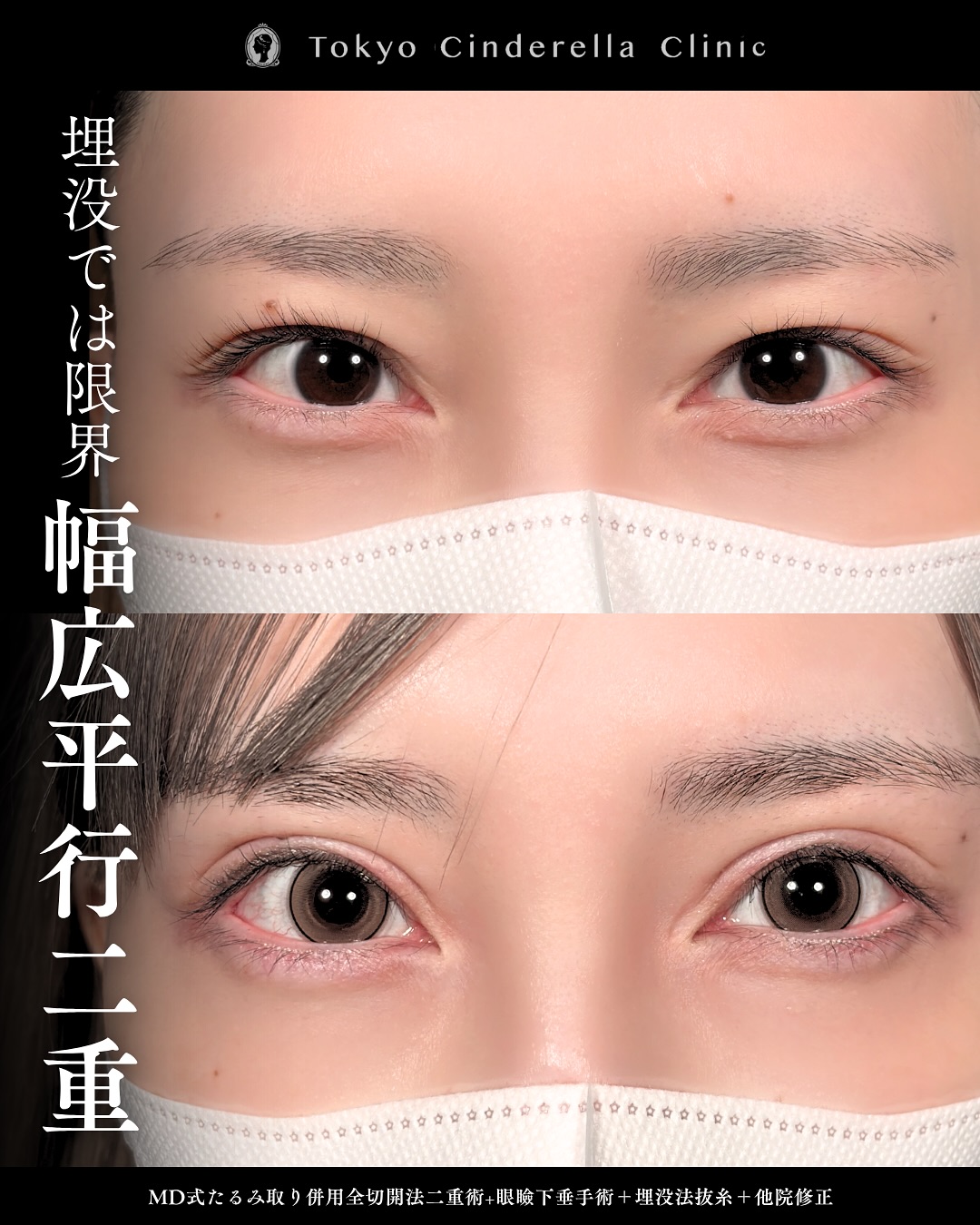 新宿院で行った二重整形で有名な吉原伯医師のMD式のたるみ取り併用全切開法二重術と眼瞼下垂手術と他院修正の1ヵ月症例写真