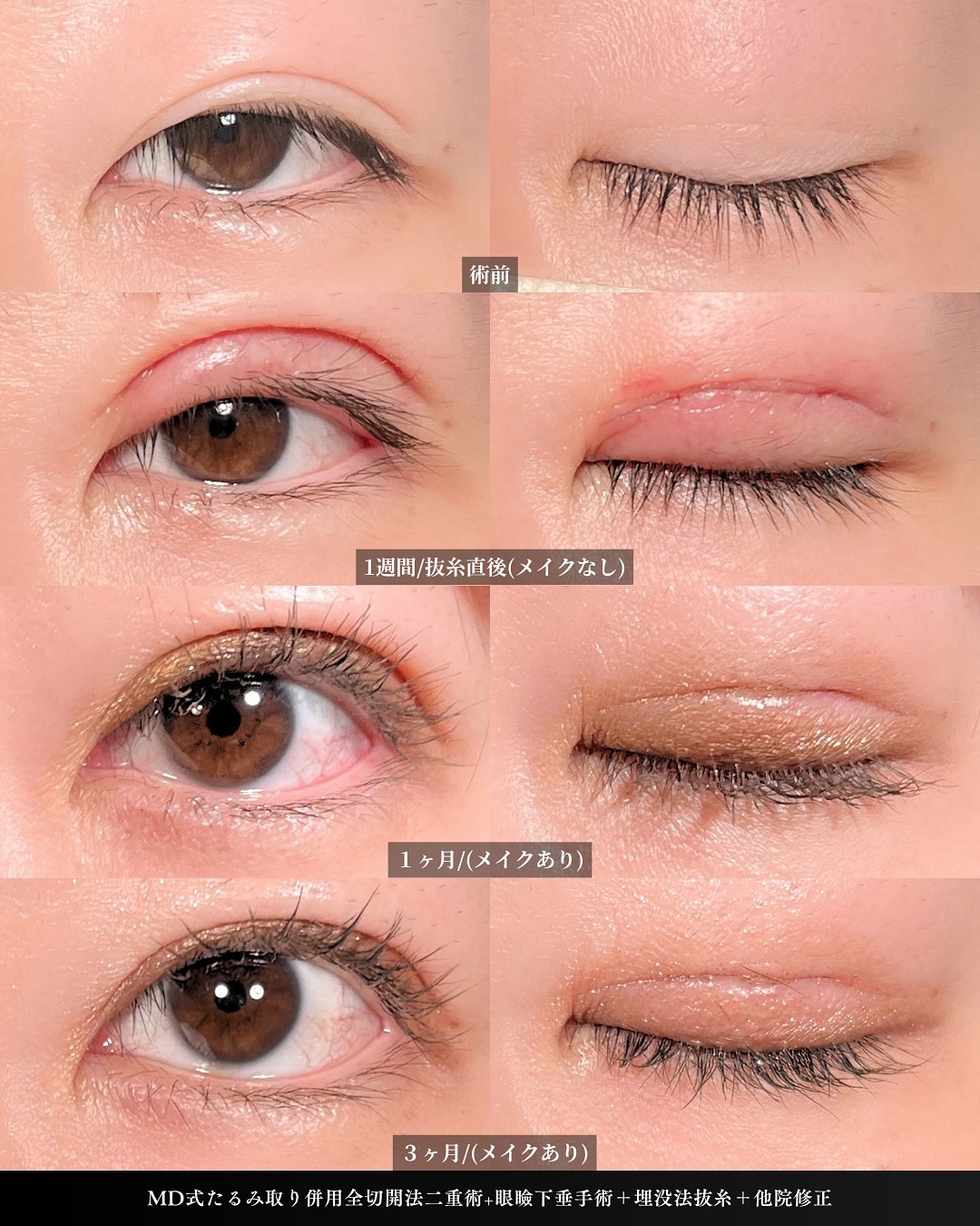 新宿院で行った二重整形で有名な吉原伯医師のMD式のたるみ取り併用全切開法二重術と眼瞼下垂手術と他院修正を行った3ヵ月までのダウンタイム症例写真