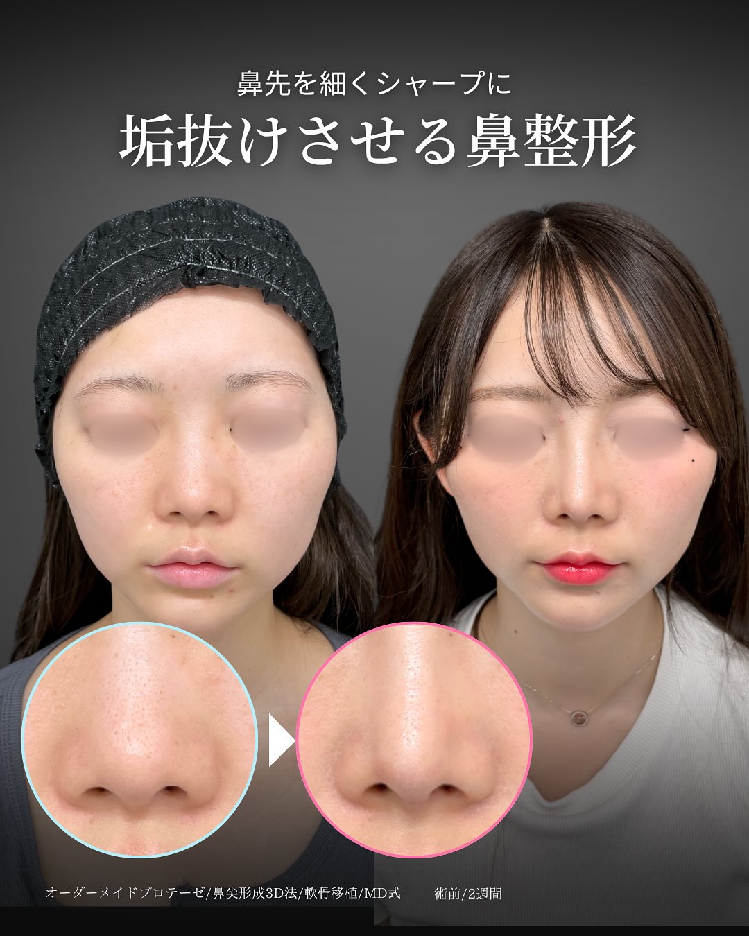 新宿院で行ったMD式鼻尖形成3D法と軟骨移植とオーダーメイドプロテーゼの2週間後の症例写真