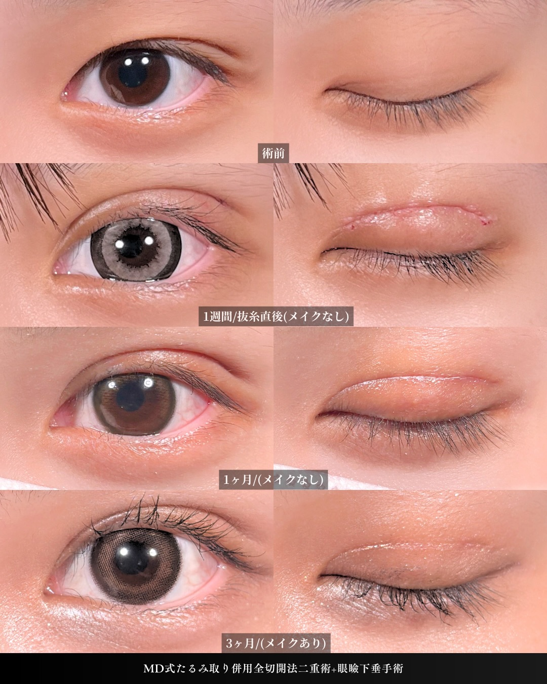 新宿院で行った二重整形で有名な吉原伯医師のMD式のたるみ取り併用全切開法二重術と眼瞼下垂手術の3ヵ月後までのダウンタイム症例写真