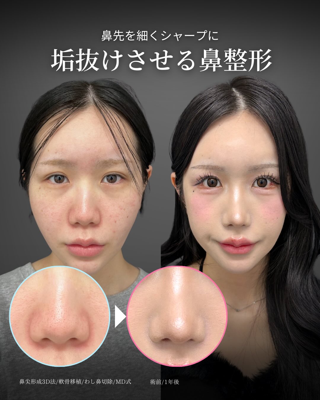 新宿院で行ったMD式の鼻尖形成3D法と軟骨移植とわし鼻切除との1年後の症例写真